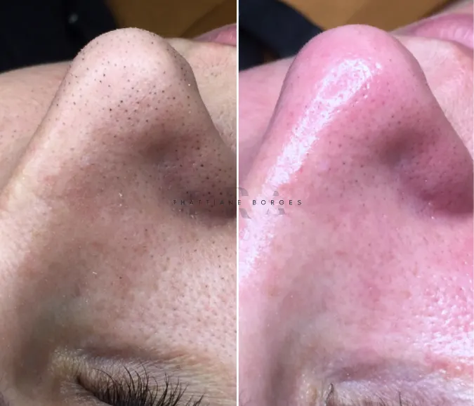 Limpeza de pele Premium Sem Dor Caso 01