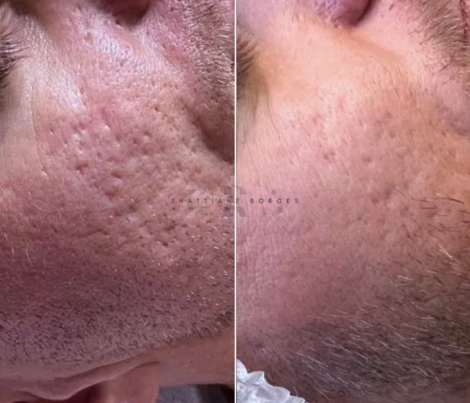 Softscar Cicatrizes de Acne caso 12