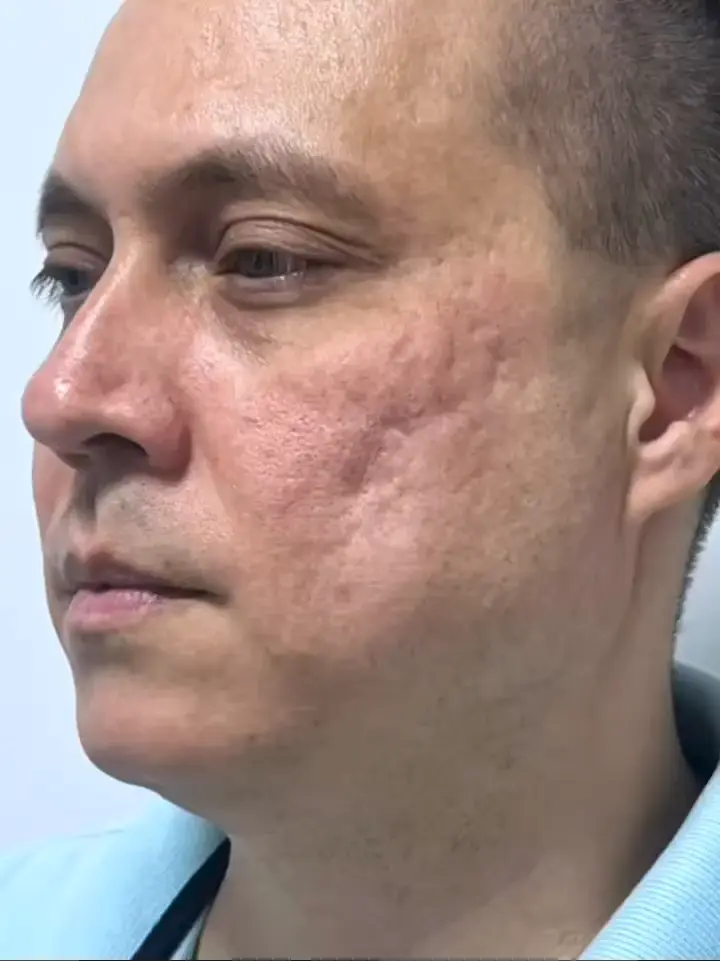 Tratamento-cicatriz-de-acne