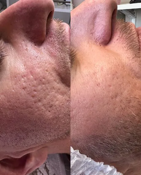 Cicatrizes de acne - Clínica estética em Canoas - Dra. Tatiane Borges