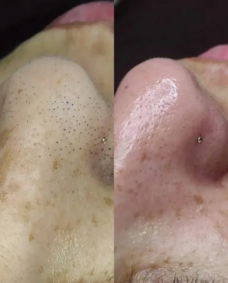 Limpeza de pele - Clínica estética em Canoas - Dra. Tatiane Borges