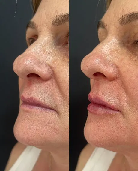 Preenchimento labial - Clínica estética em Canoas - Dra. Tatiane Borges