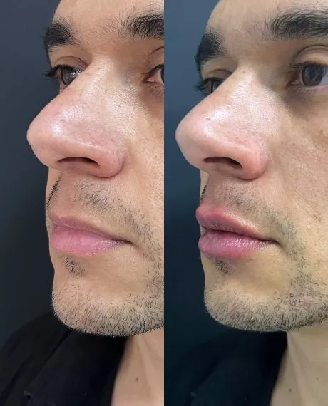 Preenchimento labial masculino